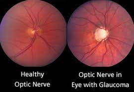 Learn more about glaucoma people who have higher eye pressure are at higher risk for glaucoma. Optic Nerve Cupping Glaucoma Research Foundation