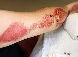 How To Treat Road Rash Active