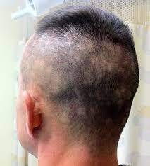 Other stis can also cause hair loss. An Usual Cause Of Progressive Hair Loss Springerlink