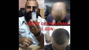 Dermaroller 540 Igneli Titanyum Sac Cikarma Taragi Seffaf Su Sac Cikartan Uygulama 1 Gun Youtube