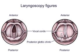 Image result for Vocal Cord Dysfunction