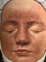 What does pellagra dermatitis & rash look like. Pellagra Altmeyers Enzyklopadie Fachbereich Dermatologie