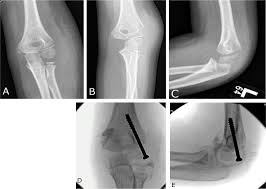 Image result for Lateral Condyle Fracture