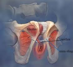 Mesh Mid Urethral Slings Your Pelvic Floor