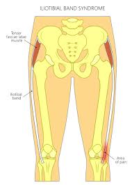 Are you having knee pain while walking downstairs? What Causes Lateral Knee Pain