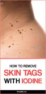 How To Remove Skin Tags Safely With Iodine Skin Tag Removal Skin Tag Iodine