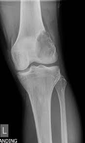 Malignant tumors can either be primary which is when they arise from the bone cells, or secondary, which is when a tumor developed somewhere else in the body, . Lucent Lytic Bone Lesion Differential Diagnosis Mnemonic Radiology Reference Article Radiopaedia Org