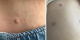 Their color varies from light to dark brown, and the border may be smooth or irregular. Gene Diagnosis Of Infantile Neurofibromatosis Type I A Case Report
