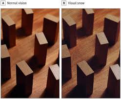 When associated with additional visual symptoms, it is referred to as visual snow syndrome. Episodic Visual Snow Associated With Migraine Attacks Jama Neurology X Mol