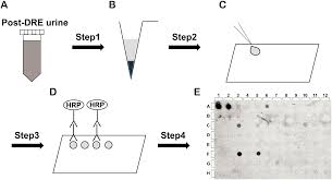 Rectal examination — intervention digital rectal exam: Plos One Detection Of Core2 B 1 6 N Acetylglucosaminyltransferase In Post Digital Rectal Examination Urine Is A Reliable Indicator For Extracapsular Extension Of Prostate Cancer