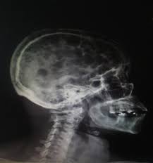 Knowing the classification of your disease is very important in deciding when it is appropriate to begin treatment. Multiple Myeloma The New York Medical Journal