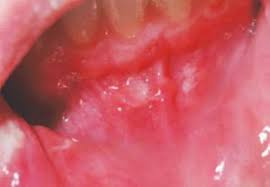 Oral Manifestations Of Crohn S Disease Decisions In Dentistry