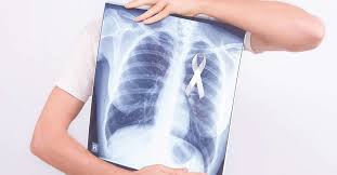 Lung, lungs, lunged, pnumonia, brokitis, pulmonary, pneumonia. Mengenal Penyakit Dan Gangguan Pada Paru Paru Tirto Id