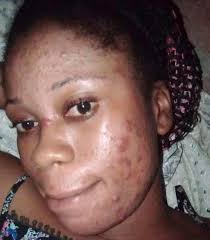 Doctors here can this be treated and if yes with what? Zziwa & Sons  Interiors Suppliers of Duvets, Bedcovers, Blankets, Bedsheets, Mosquito  nets, Wardrobes/Closets, Pillows, Towels and Bathrobes To NGO's, Hotels,  Hospitals,