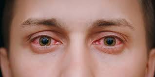 How do you say pink eye in spanish. Redness Relieving Eye Drops American Academy Of Ophthalmology