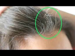 I noticed my first white hair at 17. Remove All White Hairs This One Ingredient Can Remove All Your White Hai Grey Hair Reversal Reverse Gray Hair Make Hair Thicker