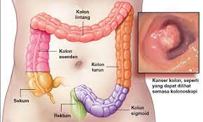 Kanser usus berada di tangga ketiga selepas kanser payudara dan serviks di kalangan wanita. Mengenali Kanser Kolorektal Utusan Borneo Online