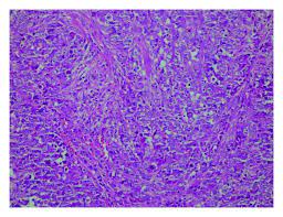 Maybe you would like to learn more about one of these? Epithelioid Type Of Malignant Mesothelioma Formed By Malignant Download Scientific Diagram