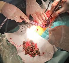 La barbati, infectia tractului urinar se poate dezvolta in uretra. Calculi Vezicali Litiaza Vezicala