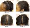 Hair Loss Treatment For Men At Home