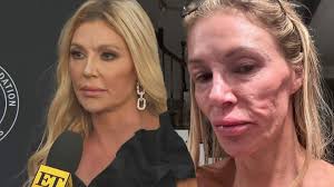 Brandi Glanville Questions If Parasite Is to Blame for Facial Disfigurement 