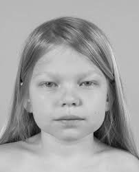 Hematopoietic cell transplantation in Hurler syndrome