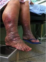 Image result for Localized Edema