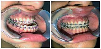 So, let's discuss how to fix an overbite after talking about its causes. Corrective Jaw Surgery Rockcliff Oral And Facial Surgery And Dental Implant Center In Asheville And Western North Carolina