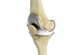 A patient's recovery and rehabilitation plan is crucial to the overall success of knee replacement surgery. Total Knee Replacement Orange County Knee Injury Fountain Valley Ca