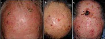 Squamous cells, basal cells, and melanocytes. Field Cancerisation Of The Forehead And Balding Scalp Including Download Scientific Diagram