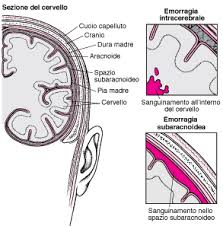 Si distinguono emorragie cerebrali a sede tipica, localizzate cioè nelle strutture profonde. Emorragia Intracerebrale Disturbi Di Cervello Midollo Spinale E Nervi Manuale Msd Versione Per I Pazienti