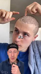 Ever wondered what the days post hair transplant look like? Take a look!,  #hairtransplantaftercare #nychairtransplant #plasticsurgeonnyc  #plasticsurgeonexplanes