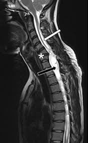 Image result for Syringomyelia