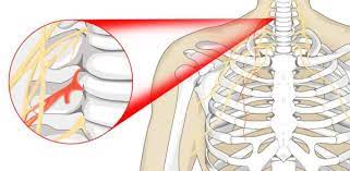 Pinched Nerve Causes, Symptoms & Treatment | Zaker Chiro