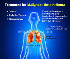 In fact, most people don't even know what it does. Treatment For Malignant Mesothelioma Surgery Radiation Chemotherapy Clinical Trial Coping Home Remedies Prevention
