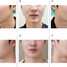 Bollard bone plates used in the present study for bone anchored...