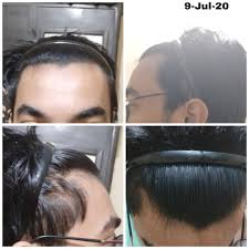 It is a very common cause of hair loss. Early Signs Hairloss