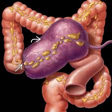Image result for Volvulus