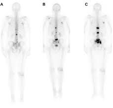 A bone scan can show whether any cancer cells have spread to your bones, which is a common place for prostate cancer to spread to. Monitoring The Response Of Bone Metastases To Treatment With Magnetic Resonance Imaging And Nuclear Medicine Techniques A Review And Position Statement By The European Organisation For Research And Treatment Of Cancer Imaging