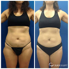 Pin On Airsculpt Before After Elite Body Sculpture