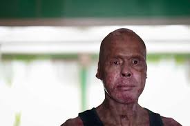 A faulty furnace. A blast of fire. And a man's life, shattered