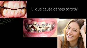 O Que Causa Os Dentes Tortos Odonto Ok