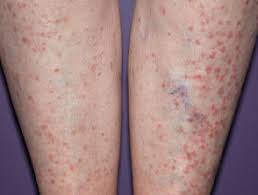 We wish you a cure and never get sick of this disease! Lichen Planus Dermnet Nz