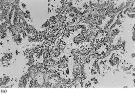 The results of a light and electron microscopic study and enzyme histochemistry of reactive mesothelial cells and diffuse and localized (solitary) pleural. Favorable And Unfavorable Morphological Prognostic Factors In Peripheral Adenocarcinoma Of The Lung 3 Cm Or Less In Diameter Lung Cancer