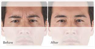 Xeomin lasts about as long as botox, 4 to 6 months realistically, 3 to 4 months. Xeomin Egea Spa