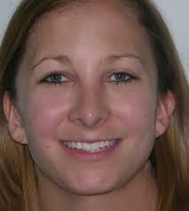 Our skilled team of physicians and medical aestheticians . Nose Surgery Before After Female Age 18 24 Greenville Sc Advanced Cosmetic Surgery