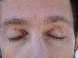 Capillaries are the ending of blood vessels that form a microscopic meshwork so oxygen and be released from the blood to the tissue, so essentially, petechiae are tiny bruises. Petechiae Purpura Or Ecchymosis Probably Purpura Whatnickdidnext