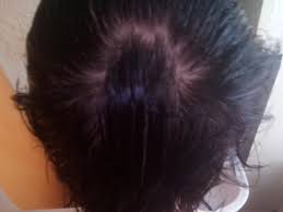 Double crown hairstyles for males men s hairstyles london s best barbers reveal how to combat six common men s hair problems from cowslicks and window s peaks to thinning hair and double crowns here s how to whip even the wildest manes into line. Double Crown Thinning Baldtruthtalk Com