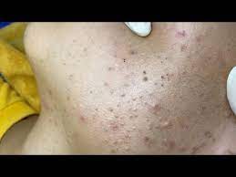 Satisfying Relaxing With Sac Dep Spa 443 Youtube In 2021 Deep Blackheads Blackheads Pimple Popping