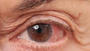 Die kryptische lyrik der ersten single auf david bowies neuem album erinnert jedoch daran, dass das ungewöhnliche aussehen seiner. David Bowie Hatte Mydriasis Das Steckt Dahinter
